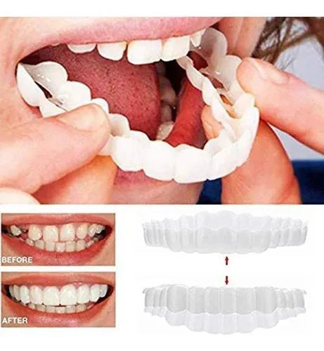Smile Veneers | ابتسامة الفينيرز التجميلية