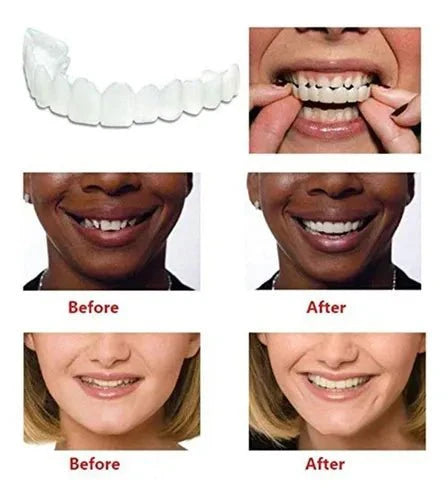 Smile Veneers | ابتسامة الفينيرز التجميلية