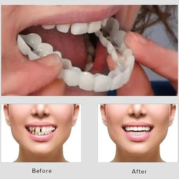 Smile Veneers | ابتسامة الفينيرز التجميلية